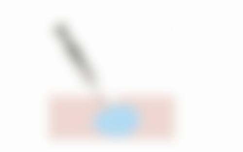 埋线双眼皮线究竟会不会断?成效维持有保护