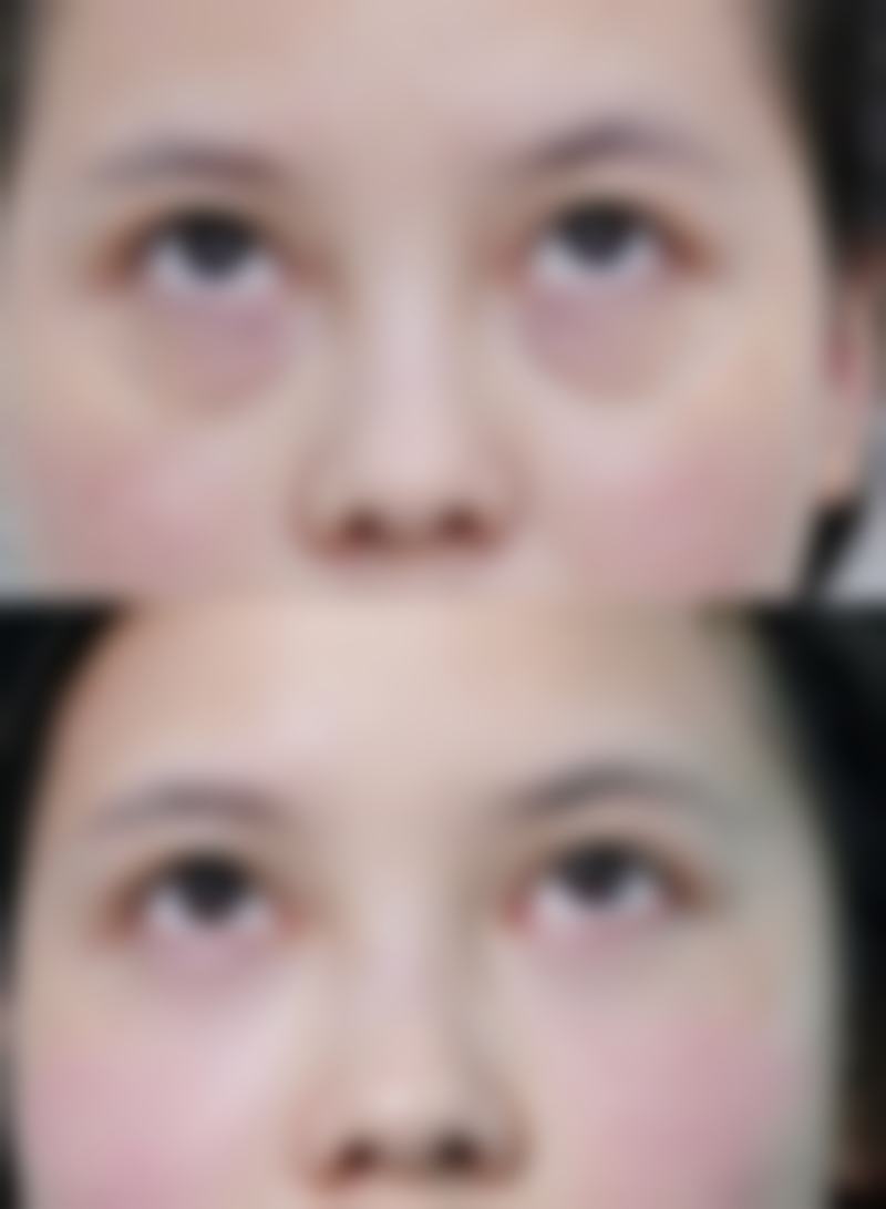 想消除眼袋鱼尾纹?物理/光电治疗显神通