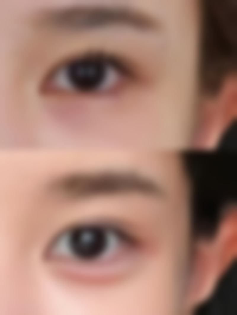 开眼角与双眼皮手术方式怎么选?