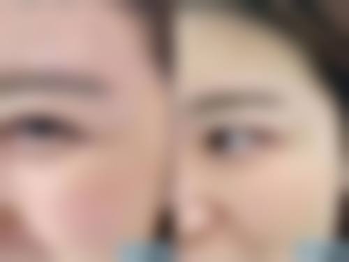 额头有疤莫担忧!精细护理来帮忙