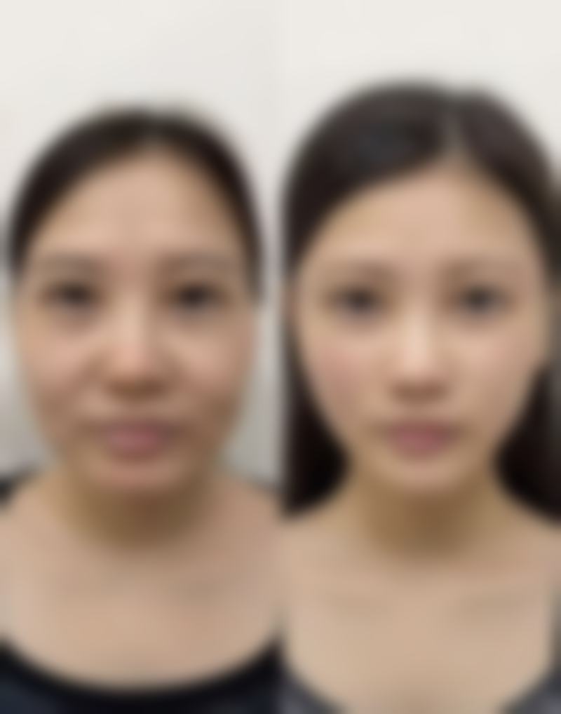 双眼皮术后喝咖啡:注意事项不能忘