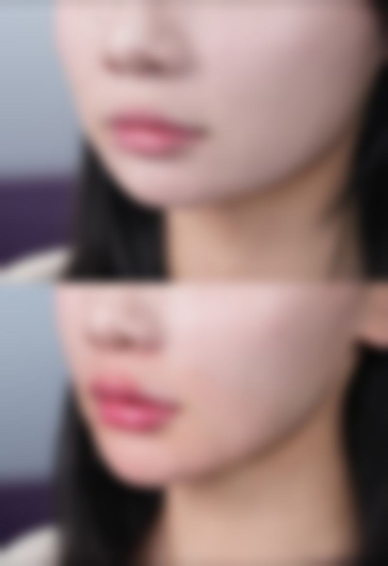 除皱针成效大揭秘:刺激胶原再生,焕肤抗衰显成效