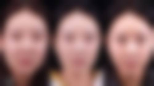 隆鼻的骨粉究竟咋用？隆鼻定义与形态