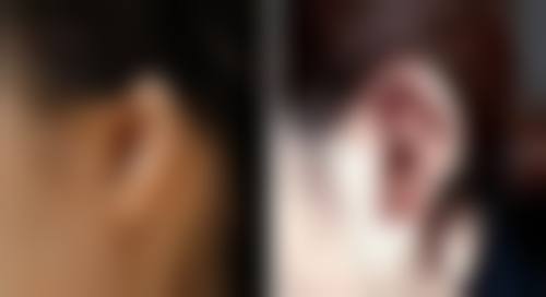 如何去除痘坑疤痕?正确认知特别重要