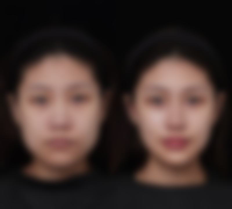 额头缝针疤痕如何完美祛除？多种有效方法助你淡化疤痕，重焕肌肤光滑