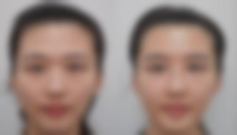 巧妙修复痘痘疤痕：多种疗法大揭秘