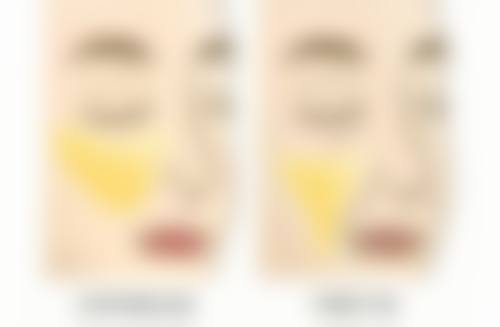 眼袋周围皱纹难消除?手术治疗有妙招