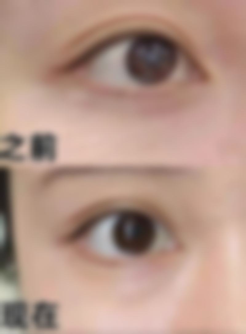 眼袋周围皱纹难消除?药物辅助与中医调理来助力