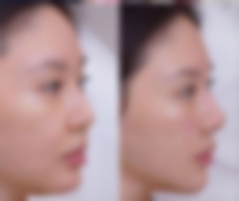 做双眼皮手术前要准备啥?身体检查不可少