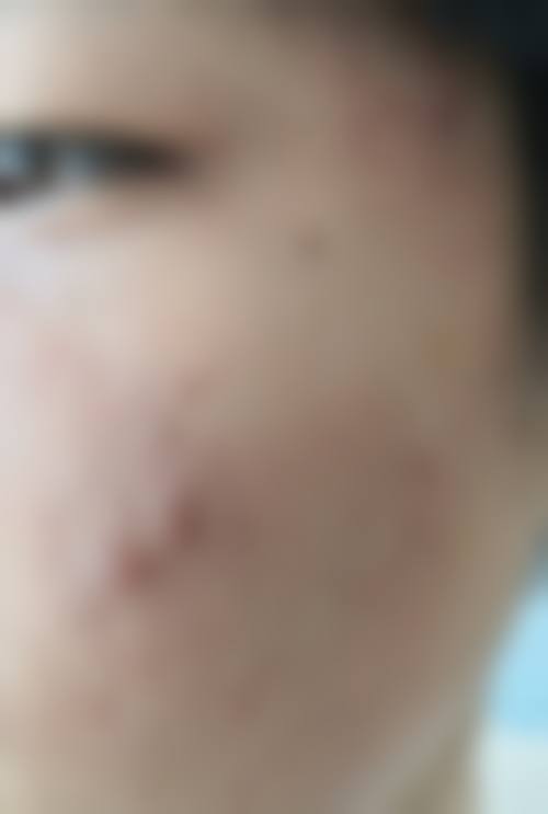 五、咸宁泉城医院皮肤美容科实例