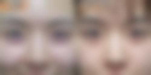 自体脂肪隆胸能否改变胸部下垂？轻中度改善佳，无需开刀还能塑形填充 